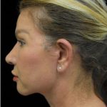 Face Lift Before & After Patient #1255