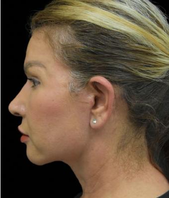 Face Lift Before & After Patient #1255