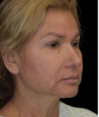 Patient #1255 Face Lift Before and After Photos Santa Ana - Plastic