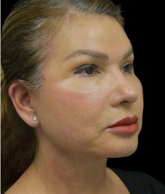 Patient #1255 Face Lift Before and After Photos Santa Ana - Plastic