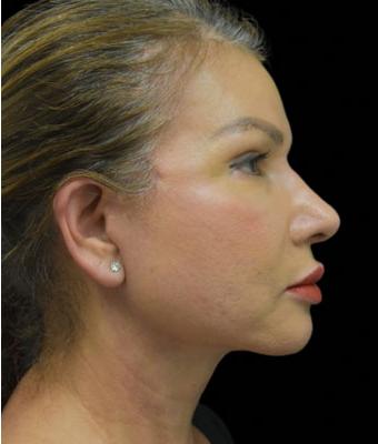 Face Lift Before & After Patient #1255