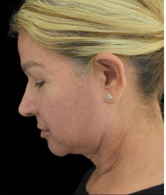 Face Lift Before & After Patient #1255