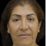 Face Lift Before & After Patient #1256
