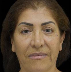 Face Lift Before & After Patient #1256