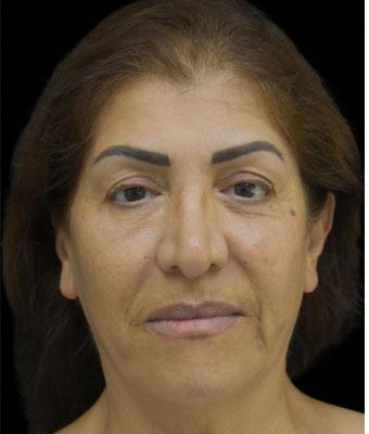 Face Lift Before & After Patient #1256