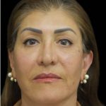 Face Lift Before & After Patient #1256