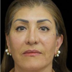 Face Lift Before & After Patient #1256