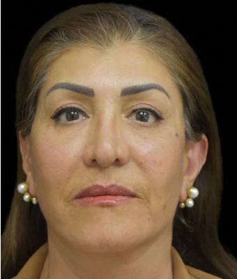 Face Lift Before & After Patient #1256
