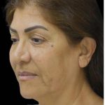 Face Lift Before & After Patient #1256