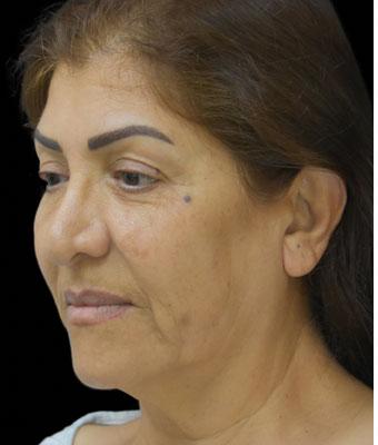 Face Lift Before & After Patient #1256