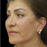Face Lift Before & After Patient #1256