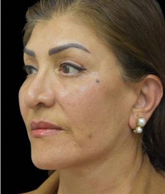 Face Lift Before & After Patient #1256