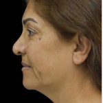 Face Lift Before & After Patient #1256