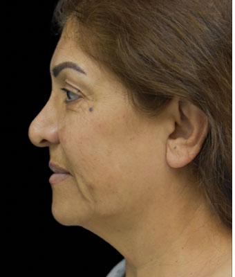 Face Lift Before & After Patient #1256