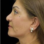 Face Lift Before & After Patient #1256