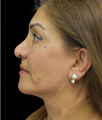Face Lift Before & After Patient #1256