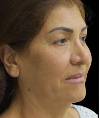 Face Lift Before & After Patient #1256