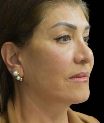 Face Lift Before & After Patient #1256