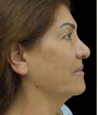 Face Lift Before & After Patient #1256