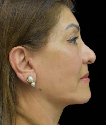 Face Lift Before & After Patient #1256