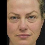 Face Lift Before & After Patient #1257