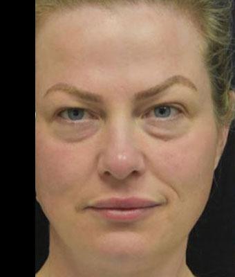 Patient #1257 Face Lift Before and After Photos Santa Ana - Plastic