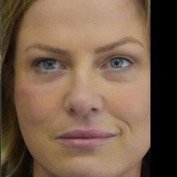 Face Lift Before & After Patient #1257