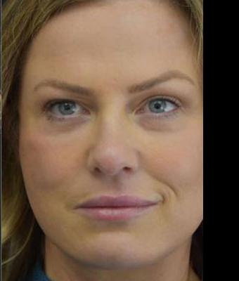 Patient #1257 Face Lift Before and After Photos Santa Ana - Plastic