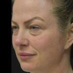 Face Lift Before & After Patient #1257