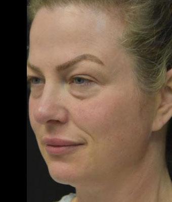 Face Lift Before & After Patient #1257