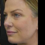 Face Lift Before & After Patient #1257