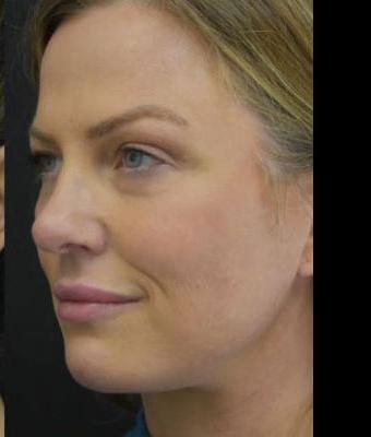 Face Lift Before & After Patient #1257
