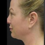 Face Lift Before & After Patient #1257