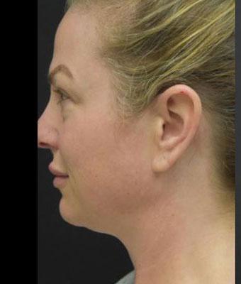 Face Lift Before & After Patient #1257