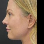 Face Lift Before & After Patient #1257