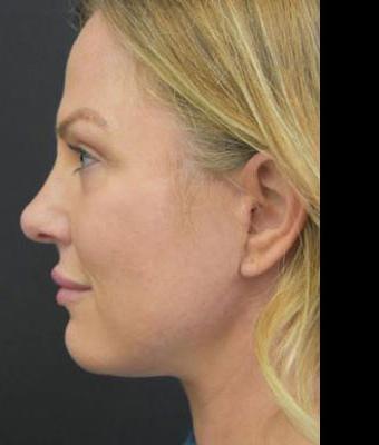 Face Lift Before & After Patient #1257