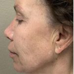 Face Lift Before & After Patient #1243