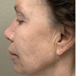 Face Lift Before & After Patient #1243