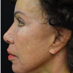 Face Lift Before & After Patient #1243