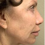 Face Lift Before & After Patient #1243