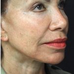 Face Lift Before & After Patient #1243