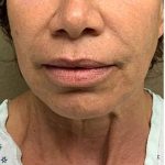Face Lift Before & After Patient #1244