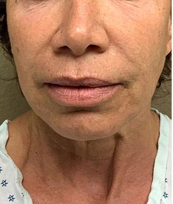 Face Lift Before & After Patient #1244