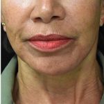 Face Lift Before & After Patient #1244