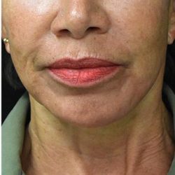 Face Lift Before & After Patient #1244