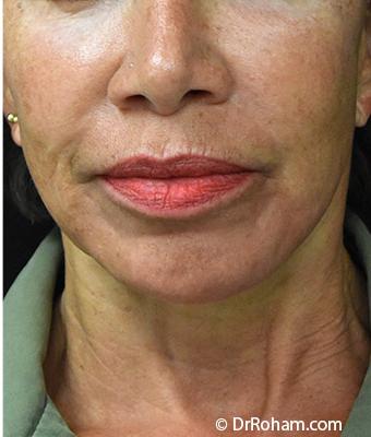 Face Lift Before & After Patient #1244