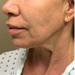 Face Lift Before & After Patient #1244