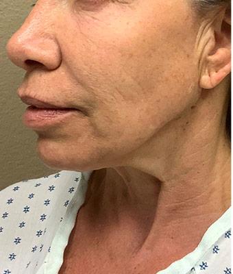 Face Lift Before & After Patient #1244