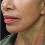 Face Lift Before & After Patient #1244