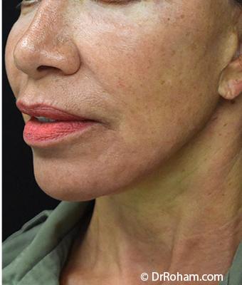 Face Lift Before & After Patient #1244